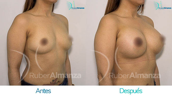 antes-y-despues-mamoplastia-bogota-colombia-dr-ruber-almanza-ym-diagonal-derecho