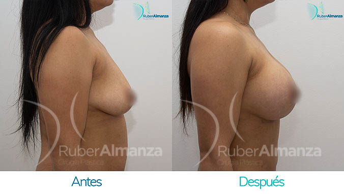 antes-y-despues-mamoplastia-bogota-colombia-dr-ruber-almanza-yvl-lateral-derecho