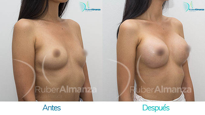 antes-y-despues-mamoplatia-bogota-colombia-dr-ruber-almanza-ajl-diagonal-derecho