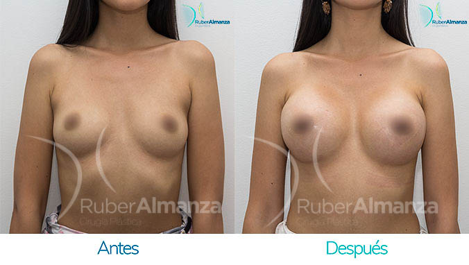 antes-y-despues-mamoplatia-bogota-colombia-dr-ruber-almanza-ajl-frontal