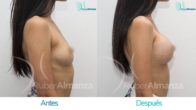 antes-y-despues-mamoplatia-bogota-colombia-dr-ruber-almanza-ajl-lateral-derecho