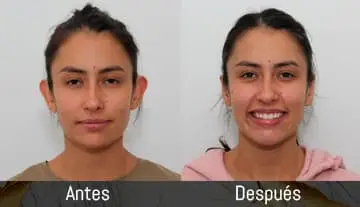 Foto para testimonio de paciente Femenina de Otoplastia caso1 en Bogotá