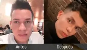 Foto para testimonio de paciente Masculino de Rinoplastia caso2 en Bogotá