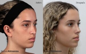Foto diagonal de un resultado de 15 días post operatorios en una Rinoplastia Femenina Realizada en Bogotá por el doctor Ruber Almanza Cirujano plástico Certificado