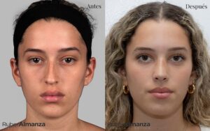 Foto de frente de un resultado de 15 días post operatorios en una Rinoplastia Femenina Realizada en Bogotá por el doctor Ruber Almanza Cirujano plástico Certificado