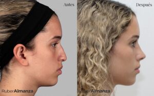 Foto de lado de un resultado de 15 días post operatorios en una Rinoplastia Femenina Realizada en Bogotá por el doctor Ruber Almanza Cirujano plástico Certificado