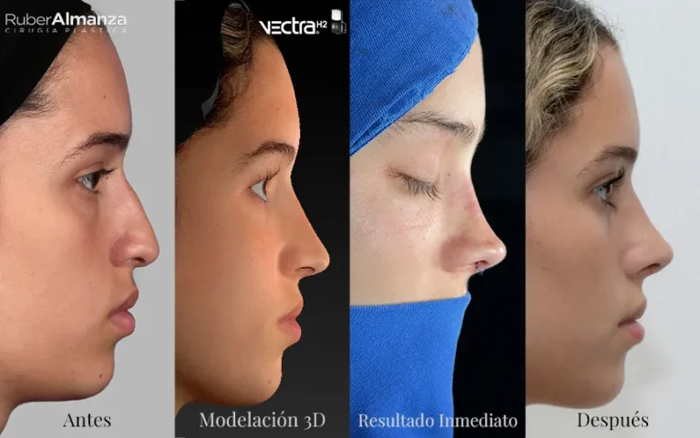 Comparativa antes modelación 3D vectra H2, después inmediato de quirófano y resultado final 15 días después de realizarce su Rinoplastia Femenina en Bogotá con el doctor Ruber Almanza Cirujano plástico Certificado
