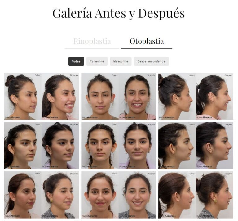 Galeria de imagenes de otoplastia casos de antes y despues realizado por el doctor Ruber Almanza en Bogotá