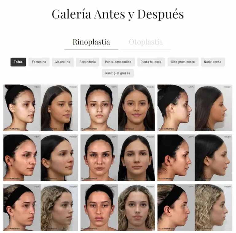 Galería de fotos de rinoplastia antes y después realizadas por el Dr Ruber Almanza en Bogota
