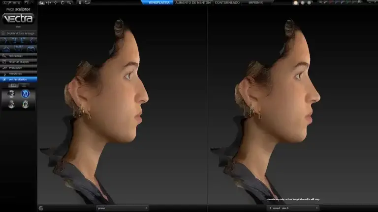 Modelacion 3D con el sistema vectra H2 Para rinoplastia femenina
