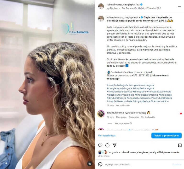 Publicacion en redes sociales de un video de antes y después de rinoplastia realizada por el doctor Ruber Almanza cirujano plastico en Bogotá Colombia