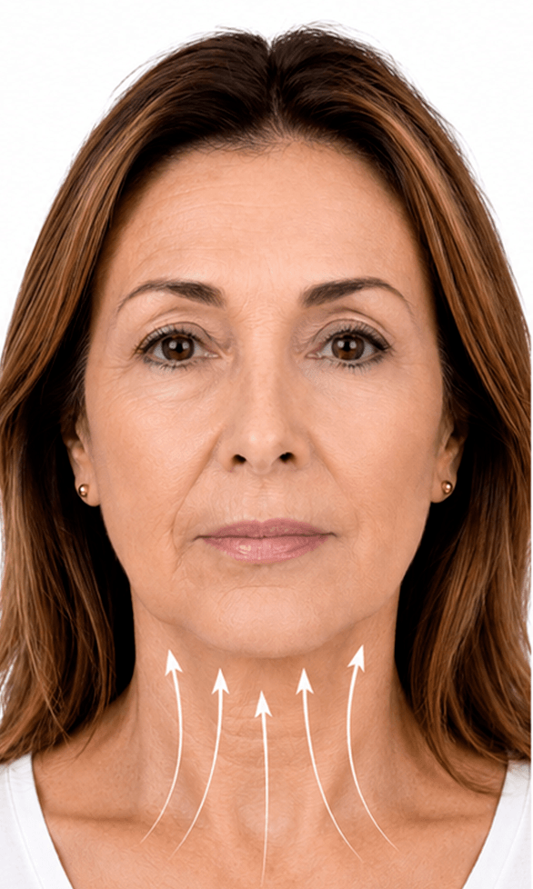 Cervicoplastia estiramiento de cuello