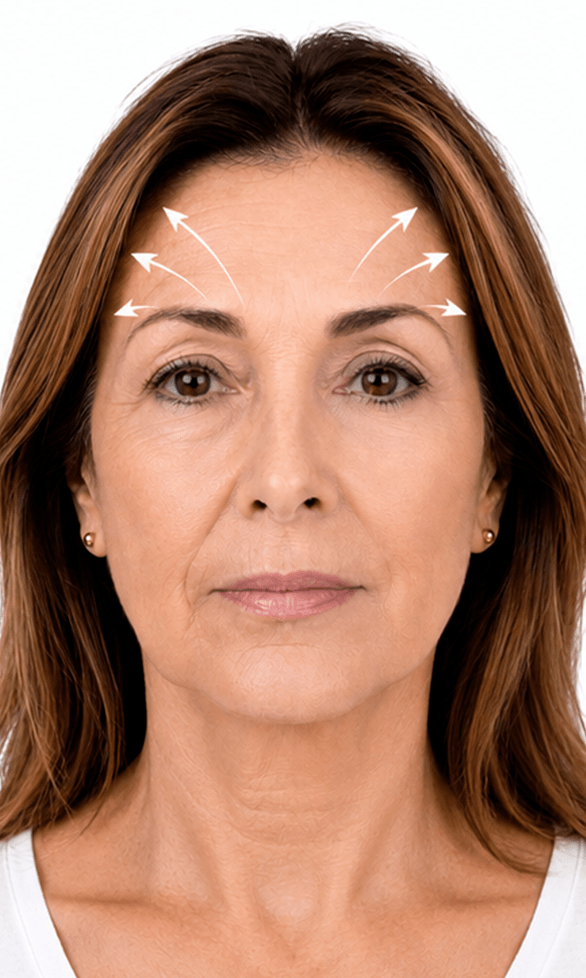 Lifting de plano superior