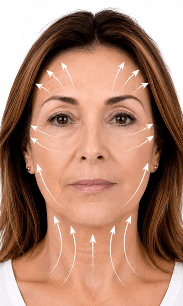 Lifting facial tipo deep plane