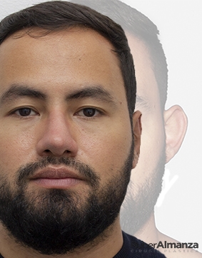 Otoplastia Masculina Dr Ruber Almanza