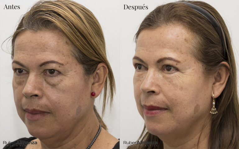 Blefaroplastia Bogota Dr Ruber Almanza Cirujano plastico MB 6