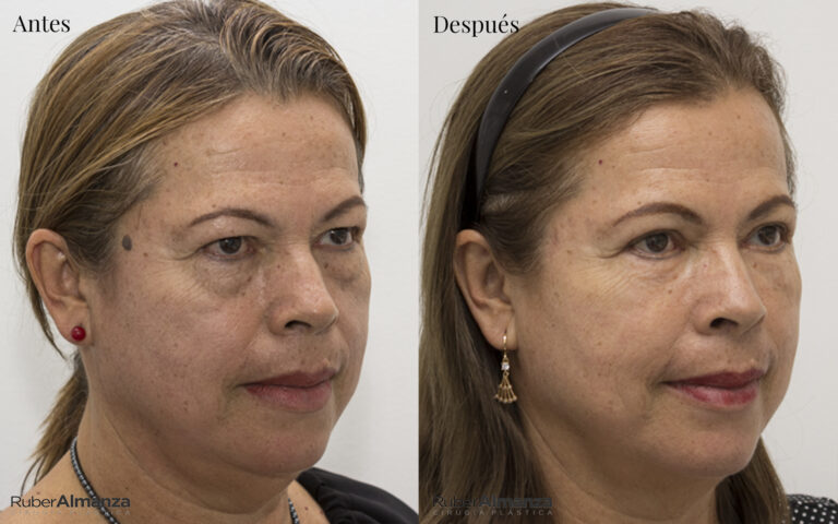 Blefaroplastia Bogota Dr Ruber Almanza Cirujano plastico MB 4