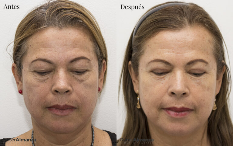 Blefaroplastia Bogota Dr Ruber Almanza Cirujano plastico MB 3