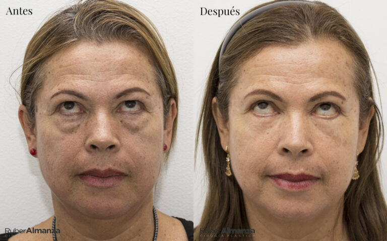 Blefaroplastia Bogota Dr Ruber Almanza Cirujano plastico MB 2