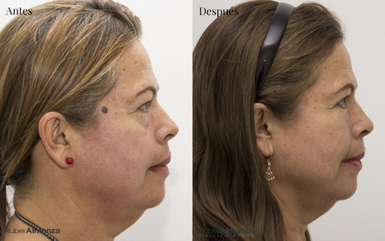 Blefaroplastia Bogota Dr Ruber Almanza Cirujano plastico MB 5