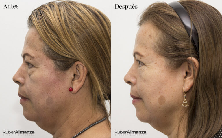 Blefaroplastia Bogota Dr Ruber Almanza Cirujano plastico MB 7