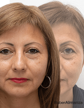 Belfaroplastia Femenina Galeria de casos