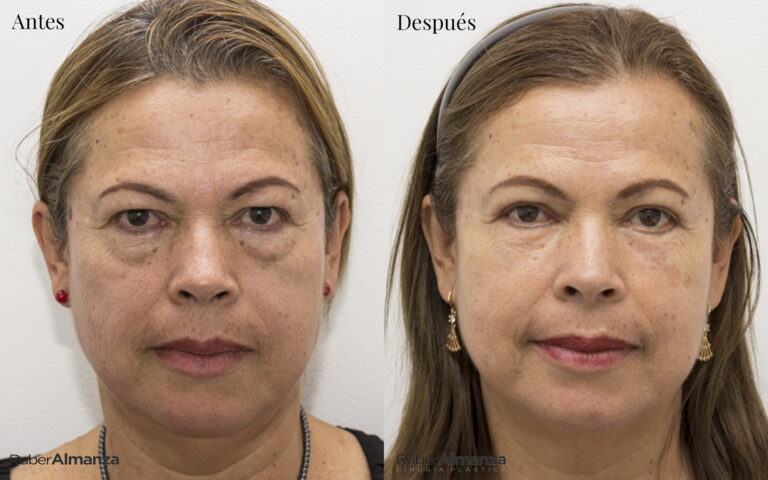 Blefaroplastia Bogota Dr Ruber Almanza Cirujano plastico MB 1